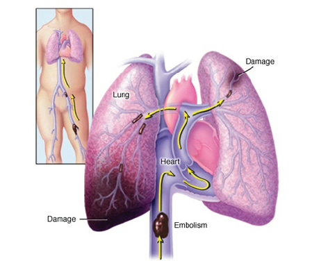 Biomedical Science &, Research Biomedgrid | Severe Pulmonary Embolism, Research